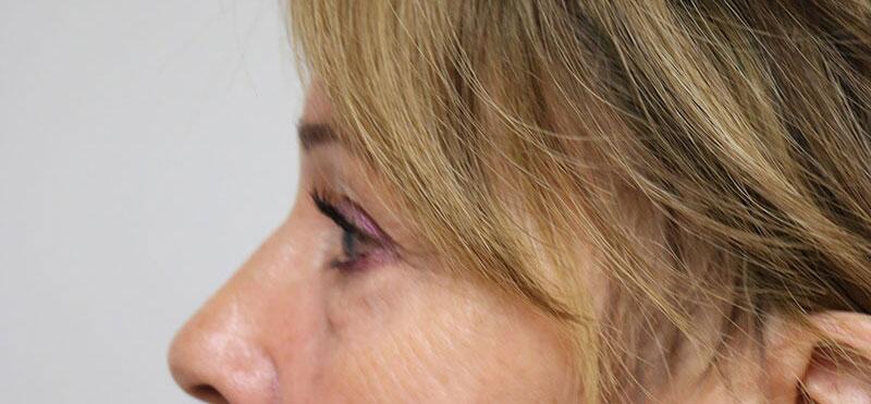 Lower Blepharoplasty Before & After Image