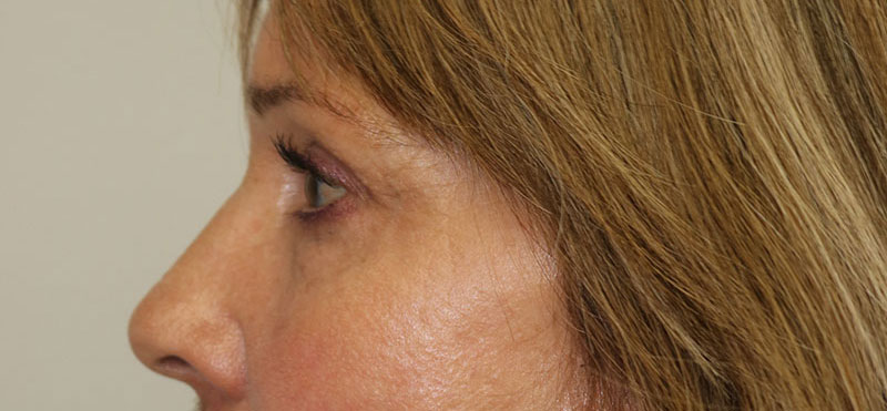 Lower Blepharoplasty Before & After Image