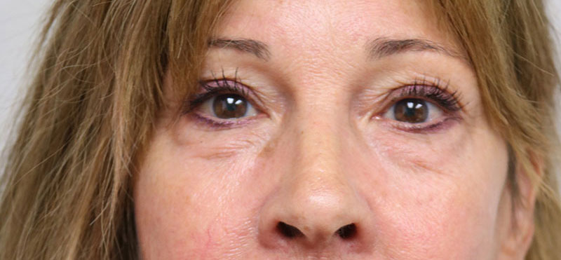 Lower Blepharoplasty Before & After Image