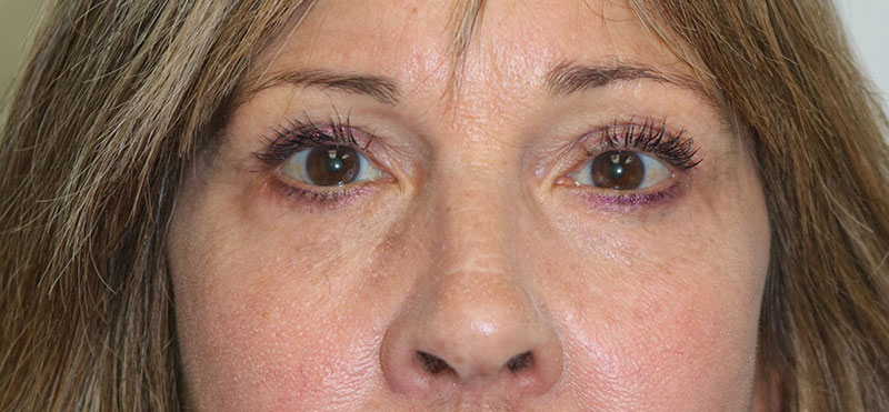 Lower Blepharoplasty Before & After Image