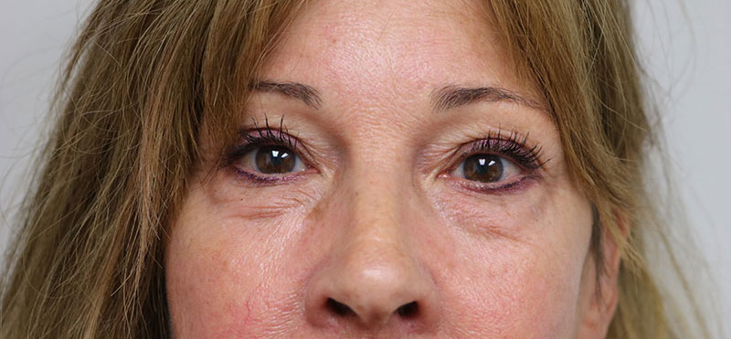 Lower Blepharoplasty Before & After Image