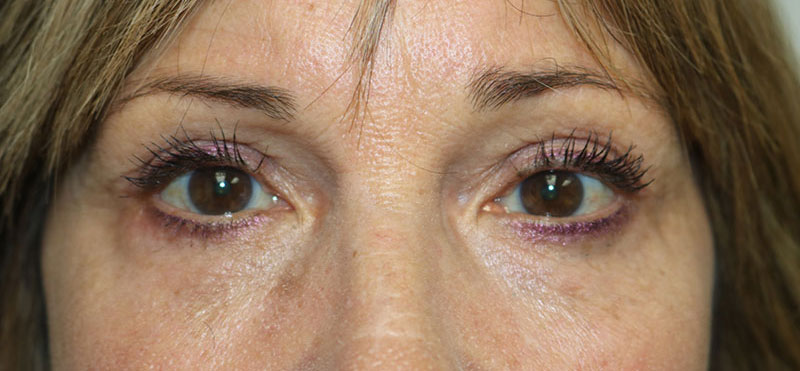 Lower Blepharoplasty Before & After Image