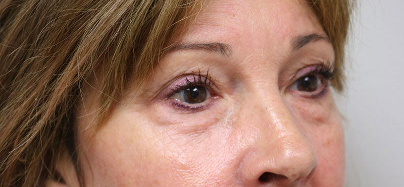 Lower Blepharoplasty Before & After Image