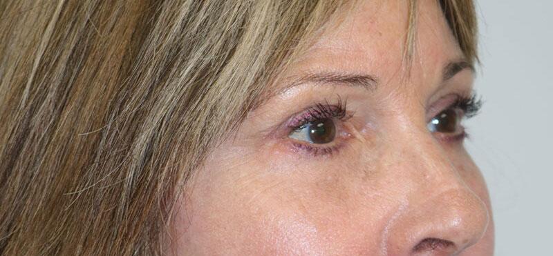 Lower Blepharoplasty Before & After Image