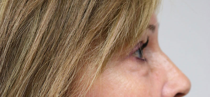 Lower Blepharoplasty Before & After Image