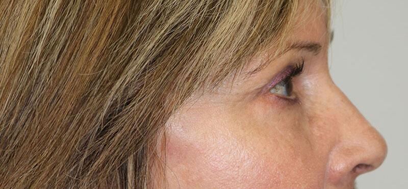 Lower Blepharoplasty Before & After Image