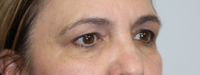Lower Blepharoplasty Before & After