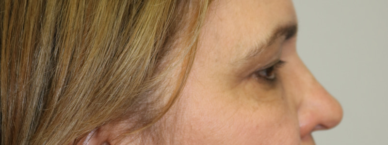 Lower Blepharoplasty Before & After