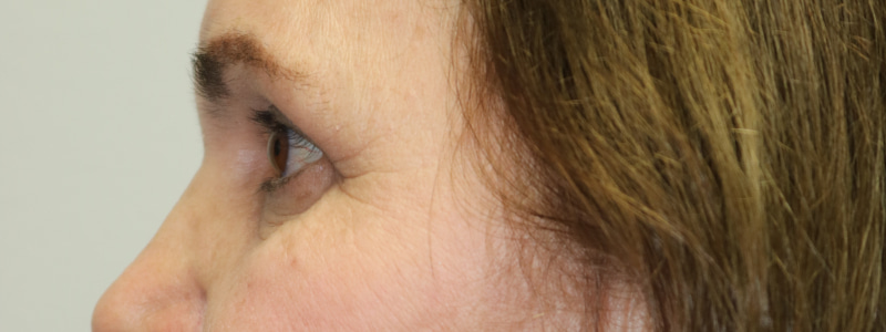 Lower Blepharoplasty Before & After