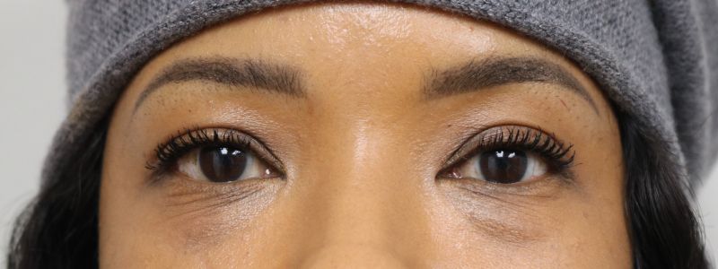 Lower Blepharoplasty Before & After