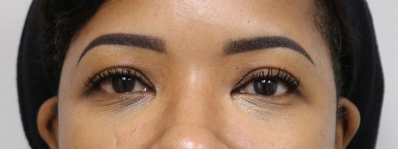 Lower Blepharoplasty Before & After