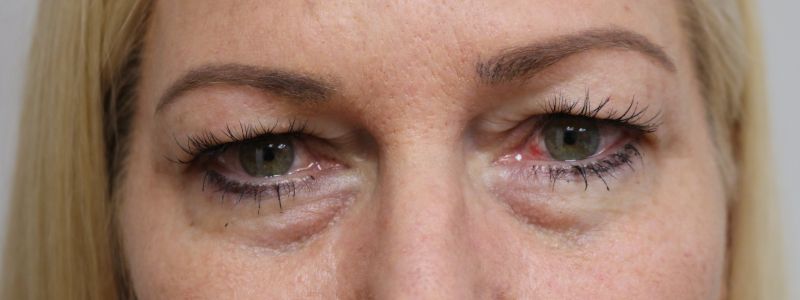 Lower Blepharoplasty Before & After