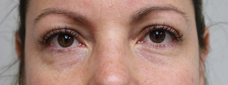 Lower Blepharoplasty Before & After