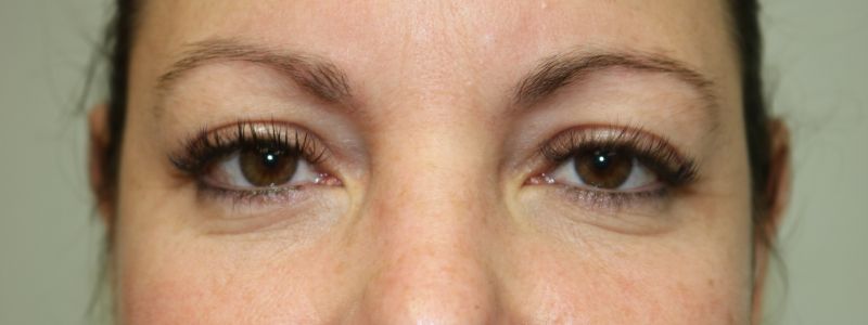 Lower Blepharoplasty Before & After