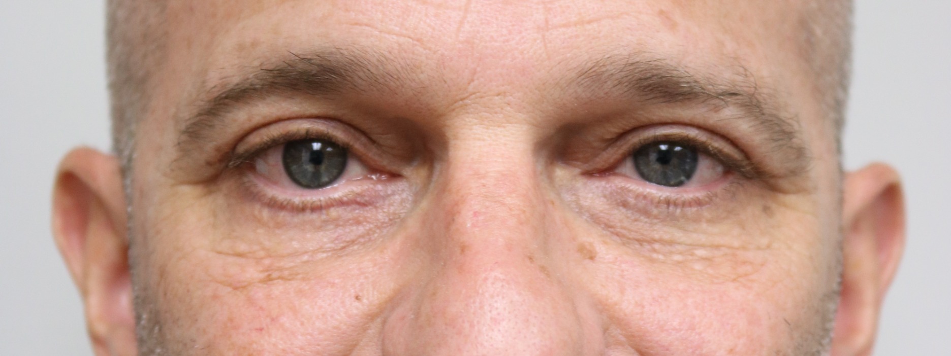 Lower Blepharoplasty Before & After