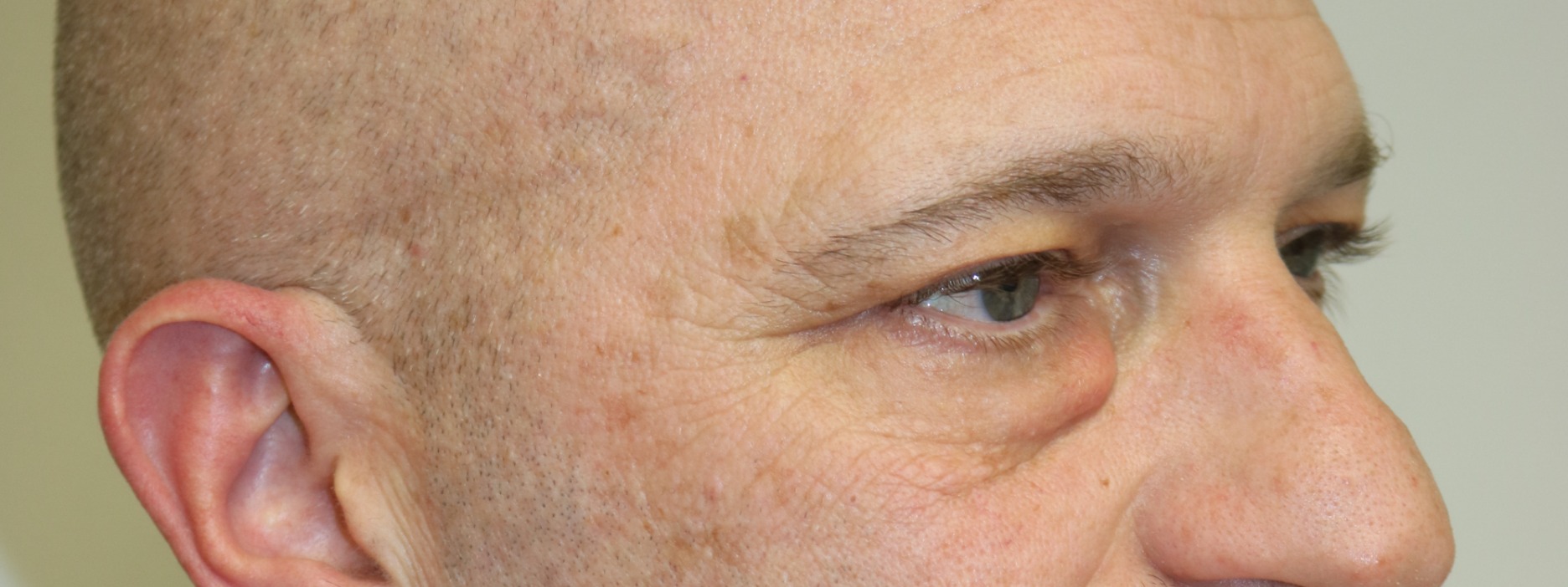 Lower Blepharoplasty Before & After