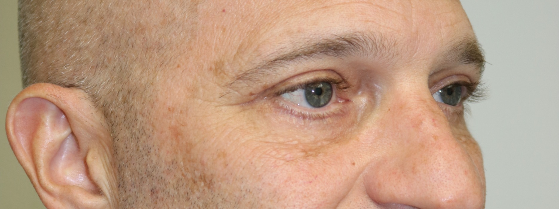 Lower Blepharoplasty Before & After