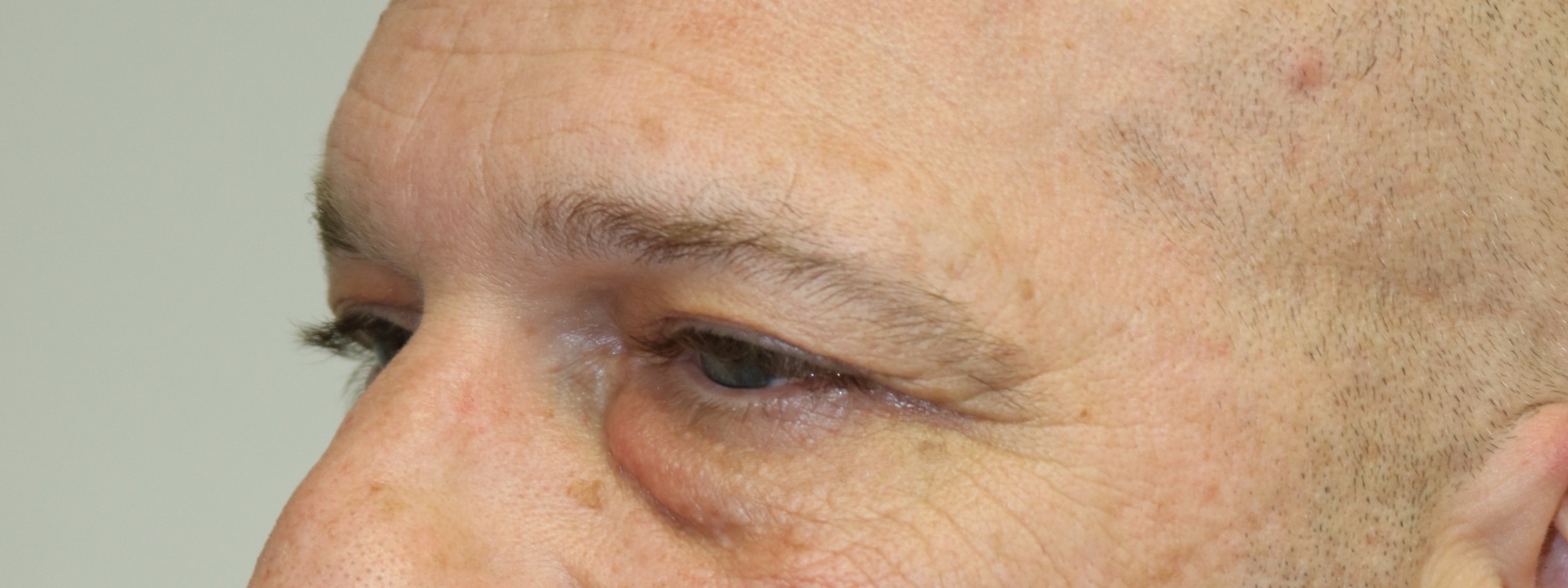 Lower Blepharoplasty Before & After