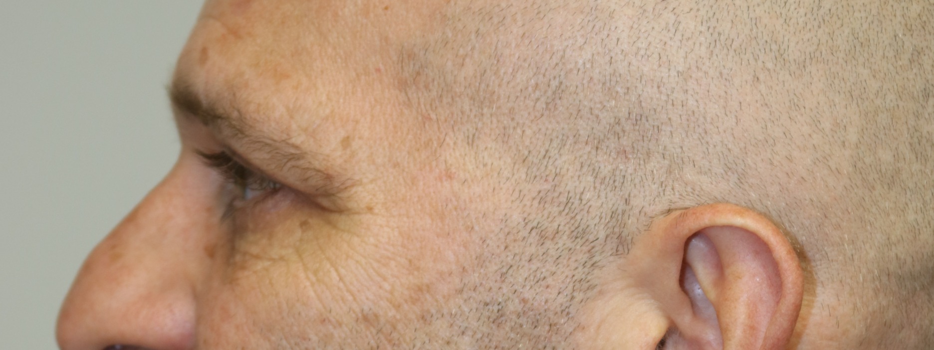 Lower Blepharoplasty Before & After