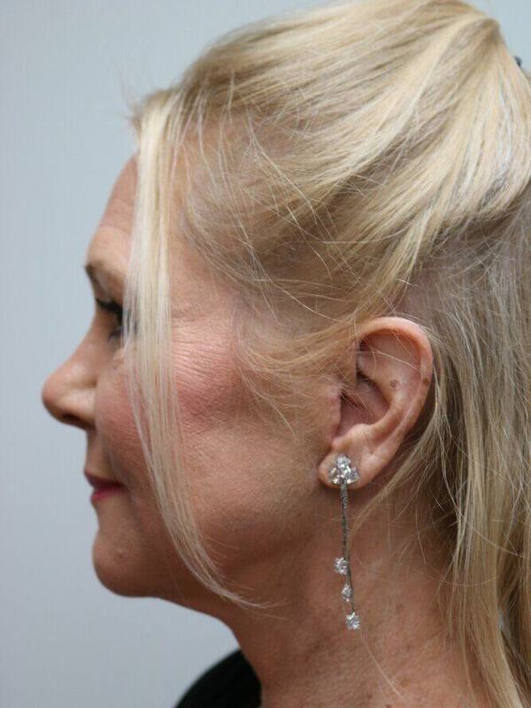 Neck Lift Before & After Image