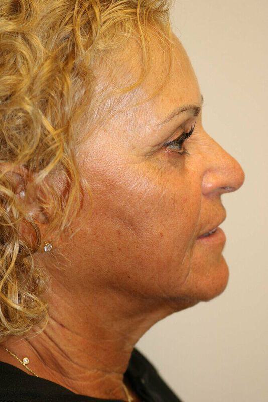 Neck Lift Before & After Image
