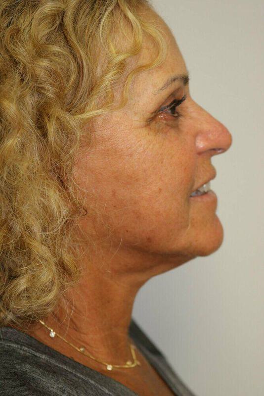 Neck Lift Before & After Image