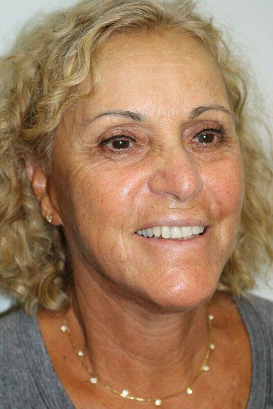 Neck Lift Before & After Image