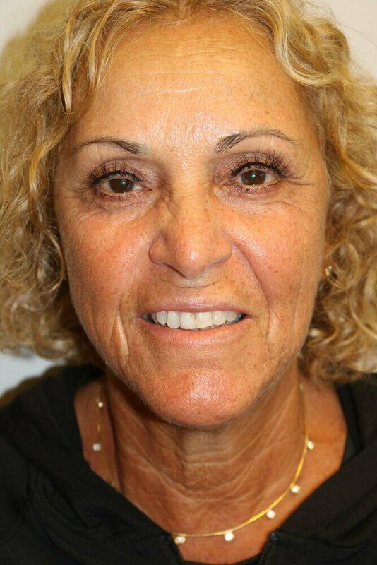 Neck Lift Before & After Image