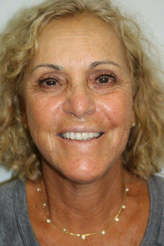 Neck Lift Before & After Image