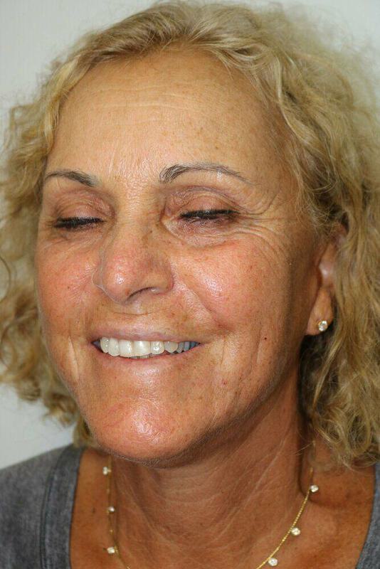 Neck Lift Before & After Image