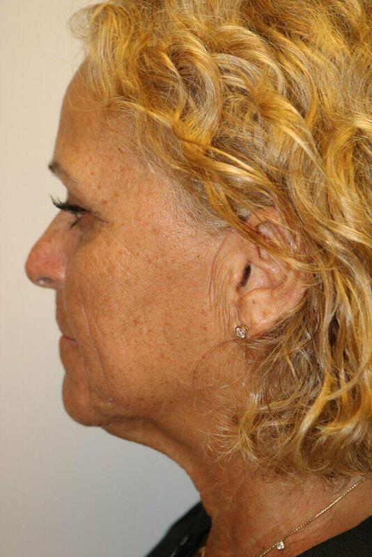 Neck Lift Before & After Image
