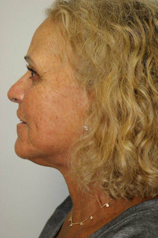 Neck Lift Before & After Image