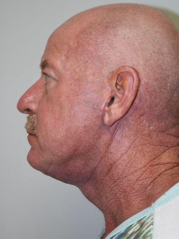 Neck Lift Before & After Image