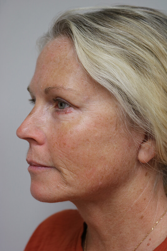 Neck Lift Before & After Image