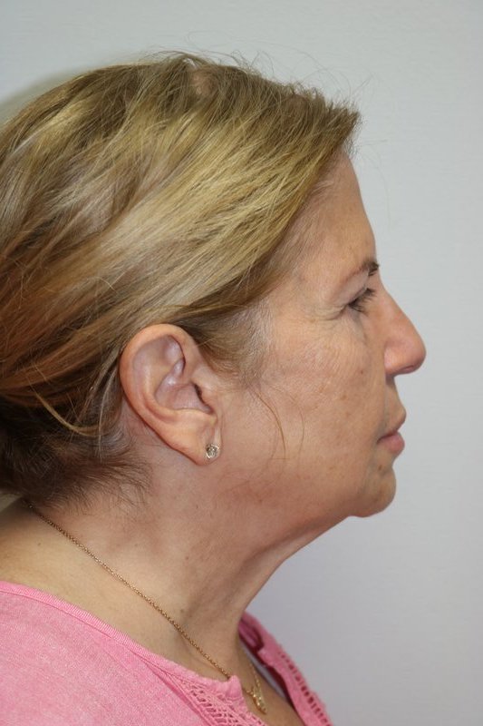 Neck Lift Before & After Image