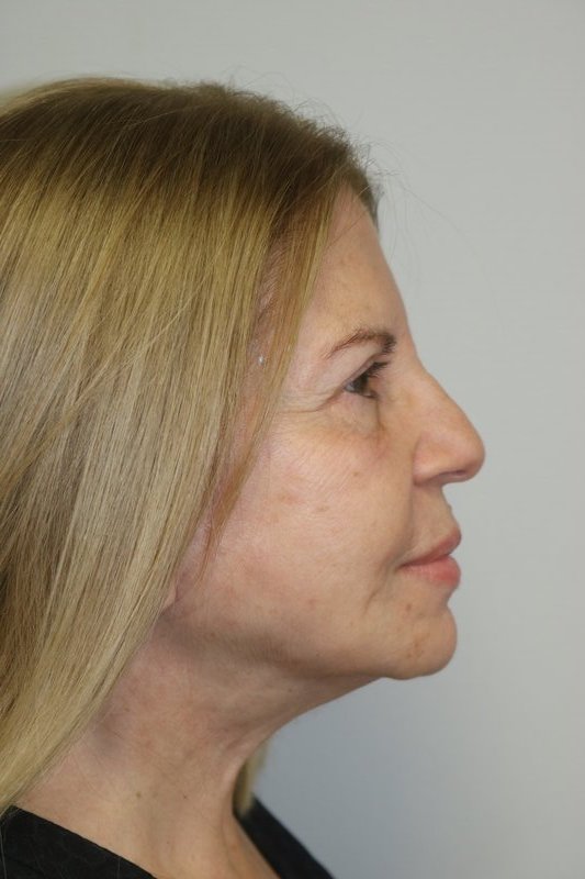 Neck Lift Before & After Image