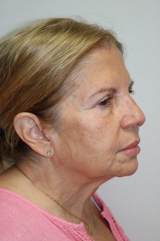 Neck Lift Before & After Image