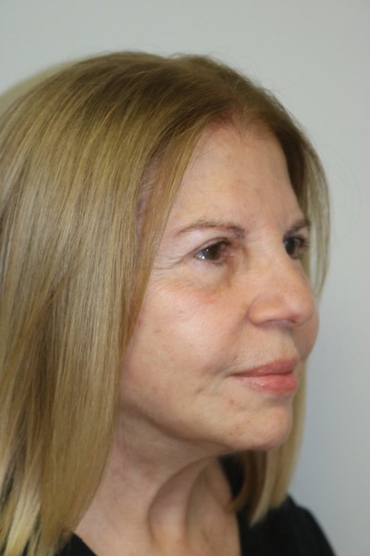 Neck Lift Before & After Image
