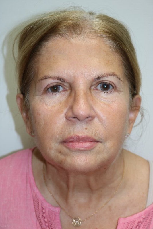 Neck Lift Before & After Image