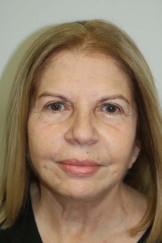 Neck Lift Before & After Image