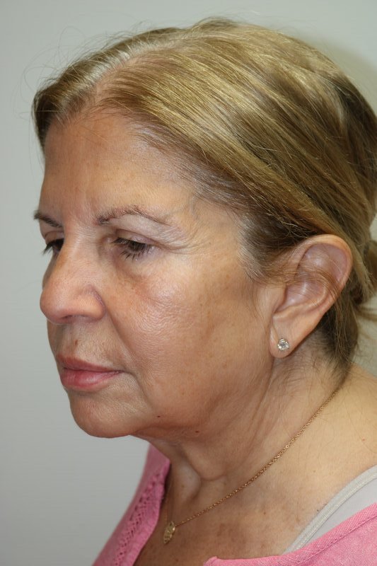 Neck Lift Before & After Image