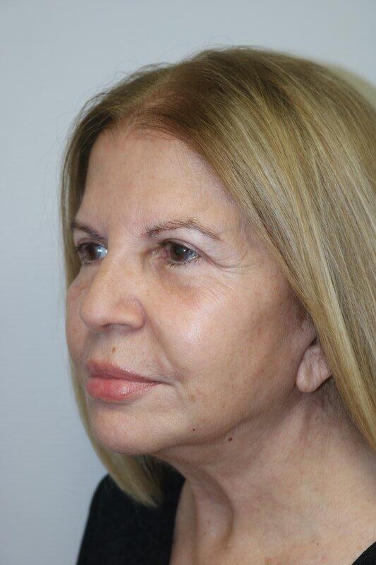 Neck Lift Before & After Image