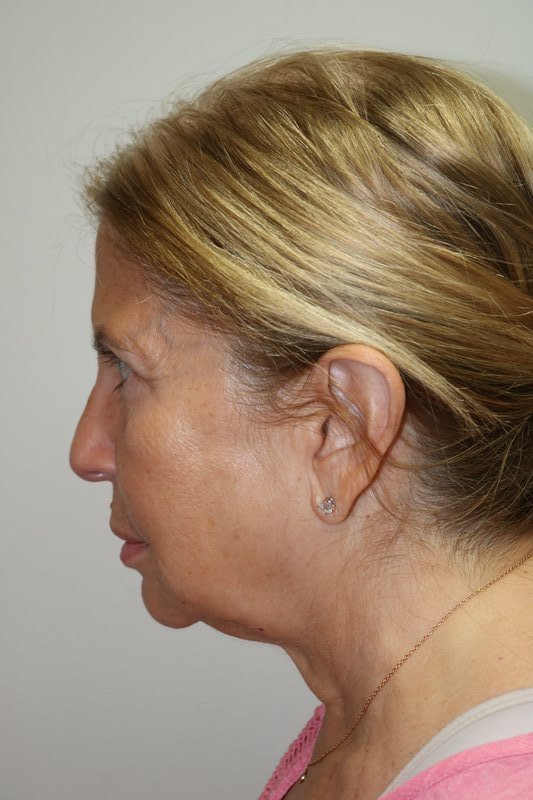 Neck Lift Before & After Image