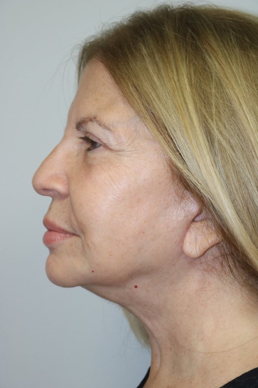 Neck Lift Before & After Image