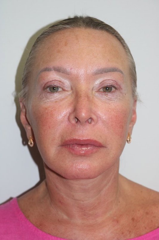 Neck Lift Before & After