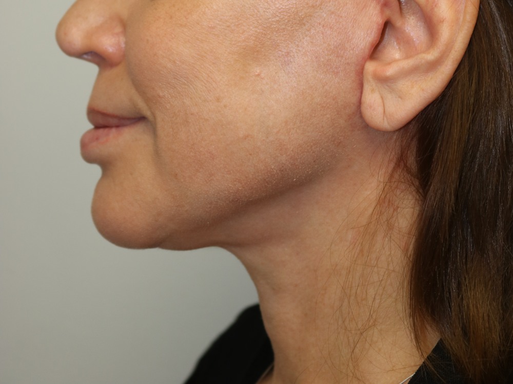 Neck Lift Before & After