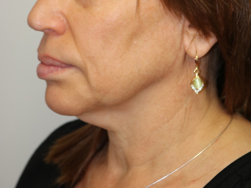Neck Lift Before & After
