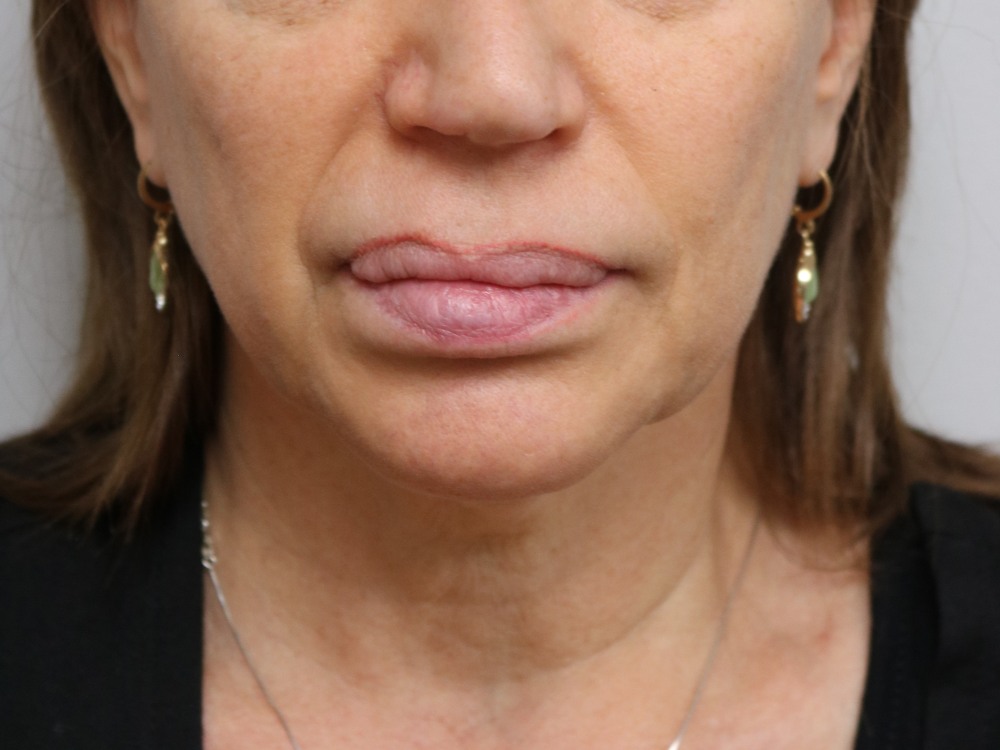 Neck Lift Before & After