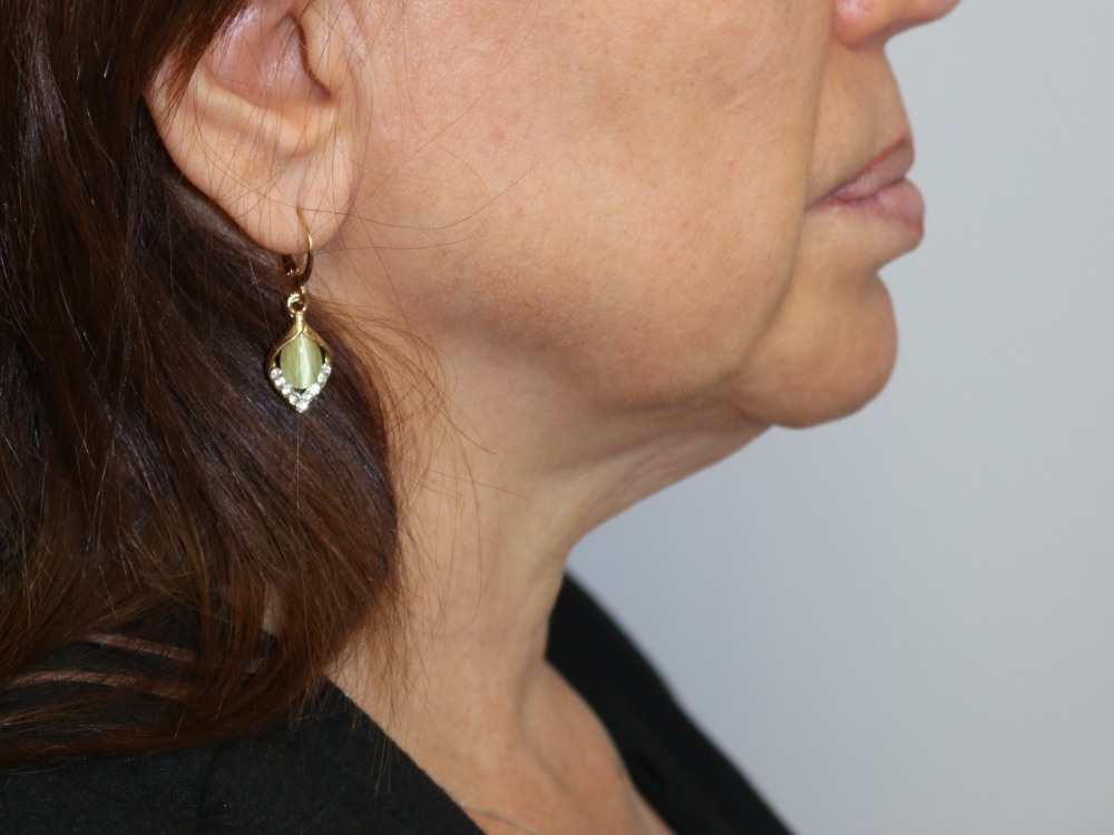 Neck Lift Before & After