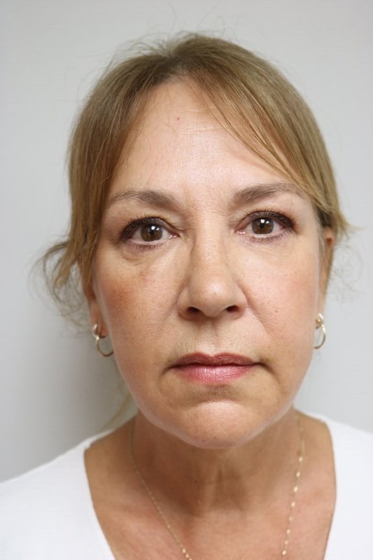 Neck Lift Before & After